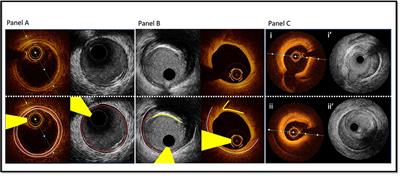 Optimising PCI by Intracoronary Image-guidance